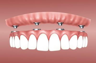 dentiste perpignan - implant dentaire